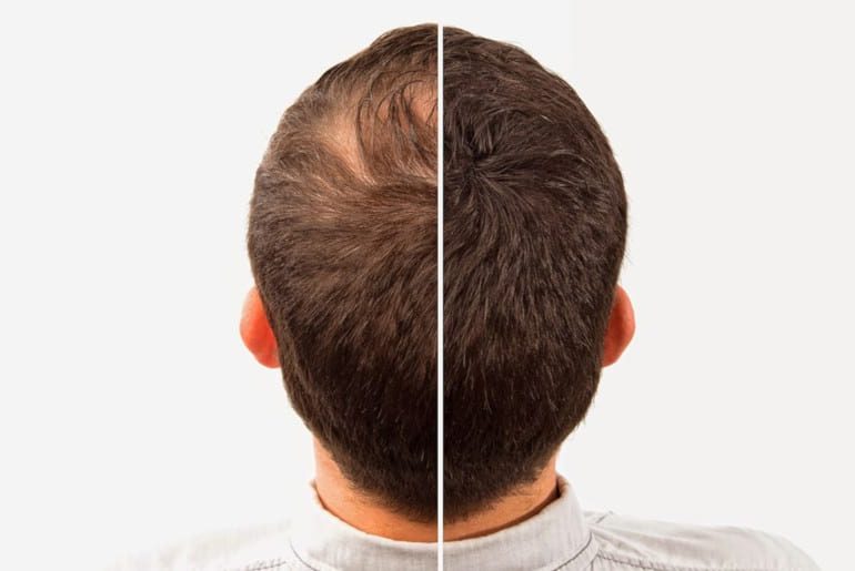 ریزش مو دلیل دارد!