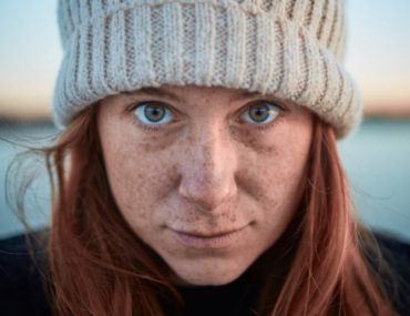 در مورد کک و مک بیشتر بدانیم