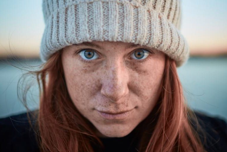 در مورد کک و مک بیشتر بدانیم