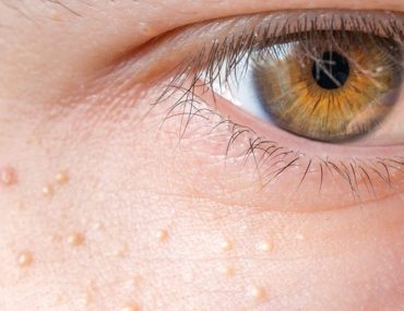 میلیا چیست و درمان آن چگونه است؟