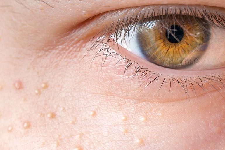 میلیا چیست و درمان آن چگونه است؟