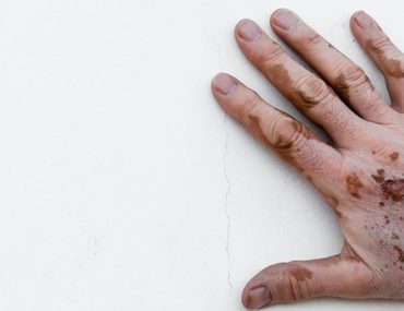 درباره ویتیلیگو یا بیماری لک و پیس بیشتر بدانیم