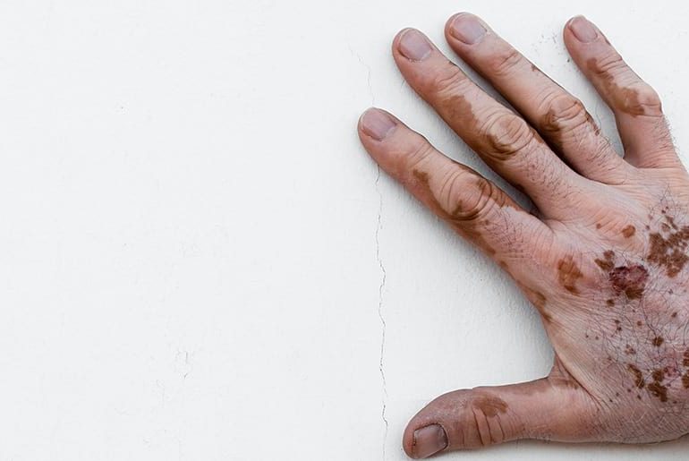 درباره ویتیلیگو یا بیماری لک و پیس بیشتر بدانیم